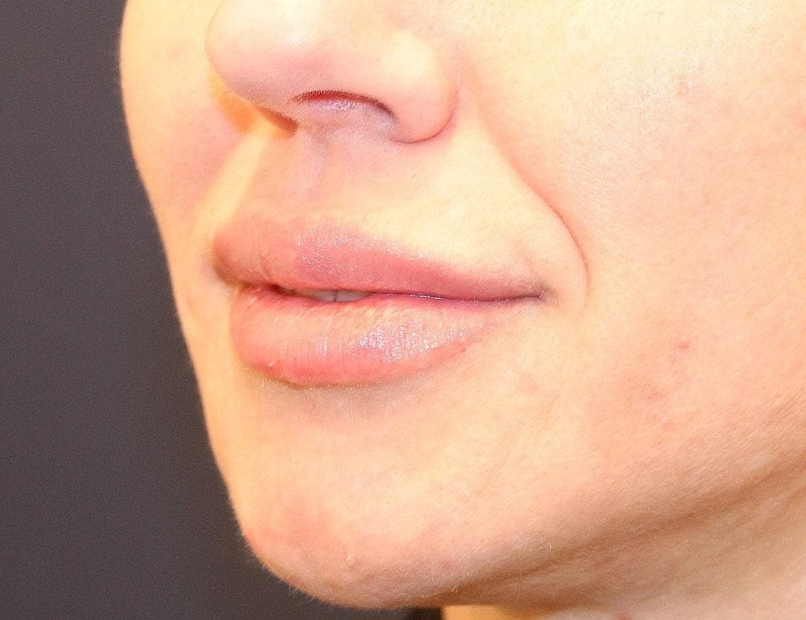 Dermal Fillers Before & After