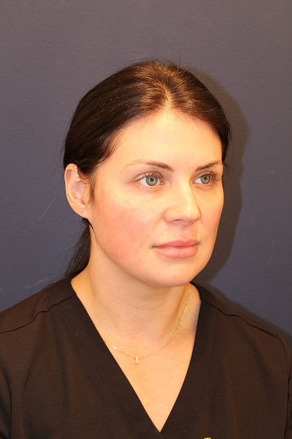Dermal Fillers Before & After
