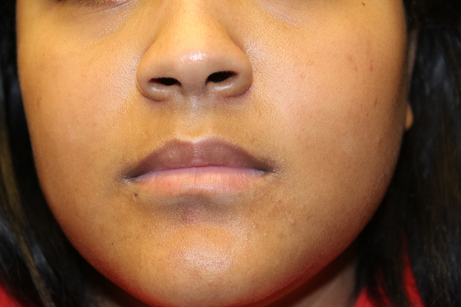 Dermal Fillers Before & After