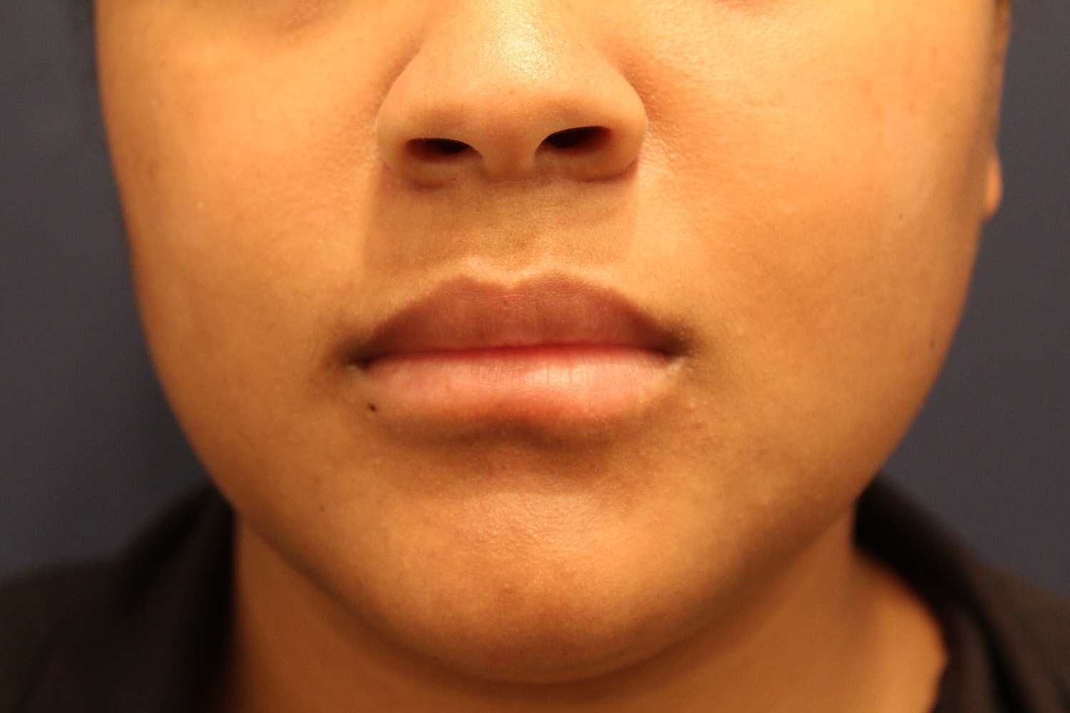 Dermal Fillers Before & After