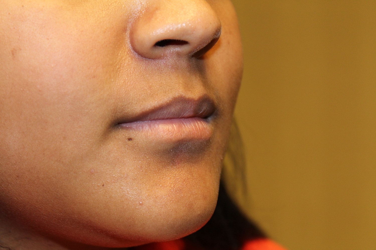 Dermal Fillers Before & After