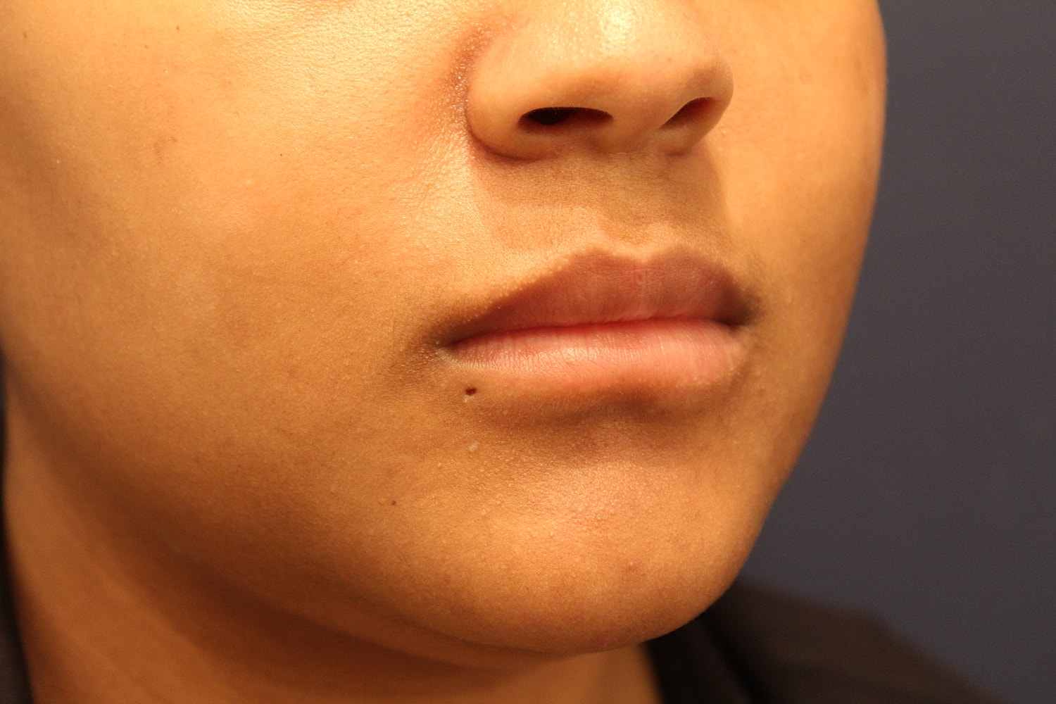 Dermal Fillers Before & After