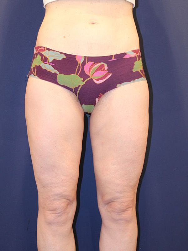 Back Lift Gallery Before & After