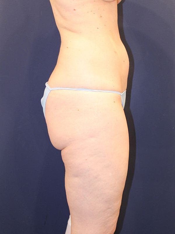 Back Lift Gallery Before & After