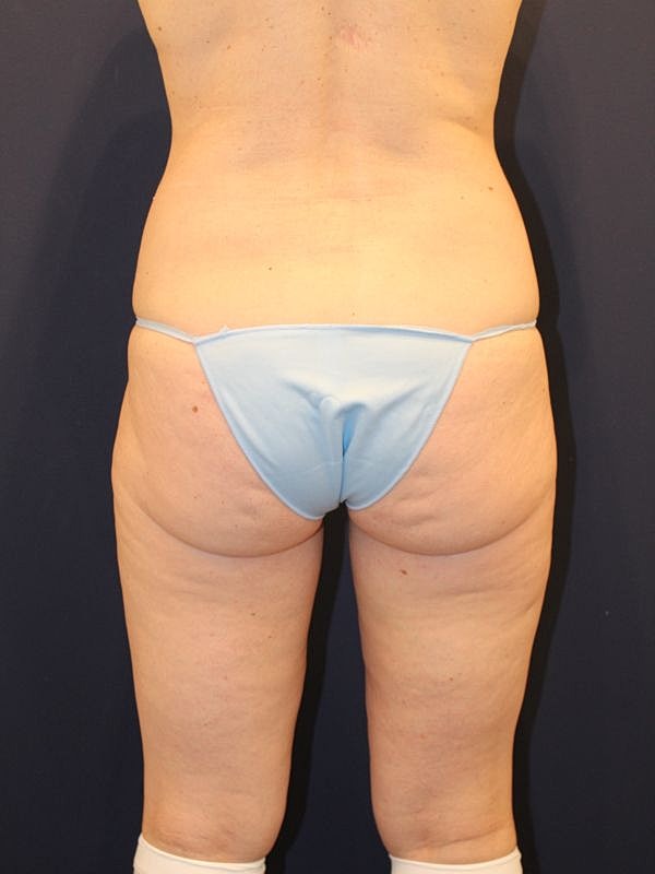 Back Lift Gallery Before & After