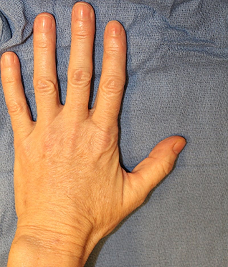 Hand Rejuvenation Before & After