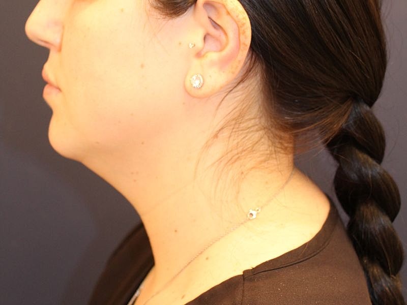 Kybella Gallery Before & After
