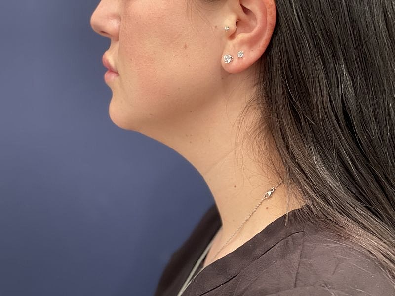 Kybella Gallery Before & After