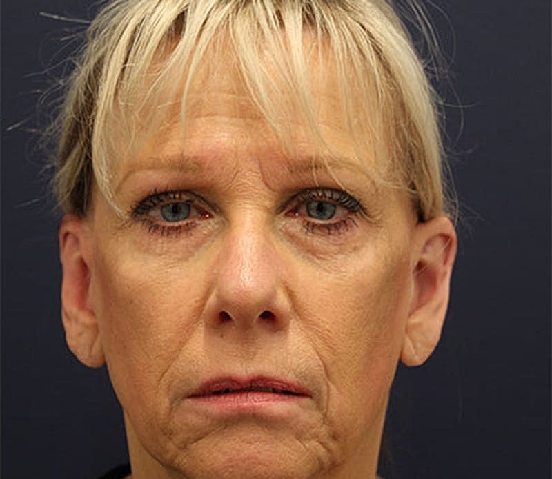 Otoplasty Before & After