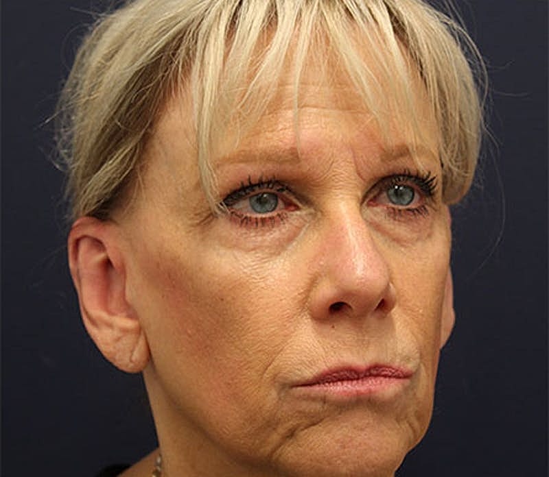 Otoplasty Before & After