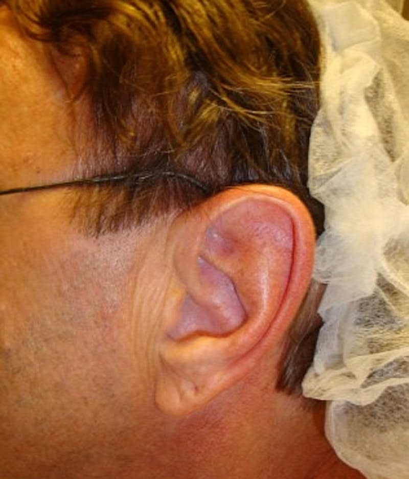 Otoplasty Before & After