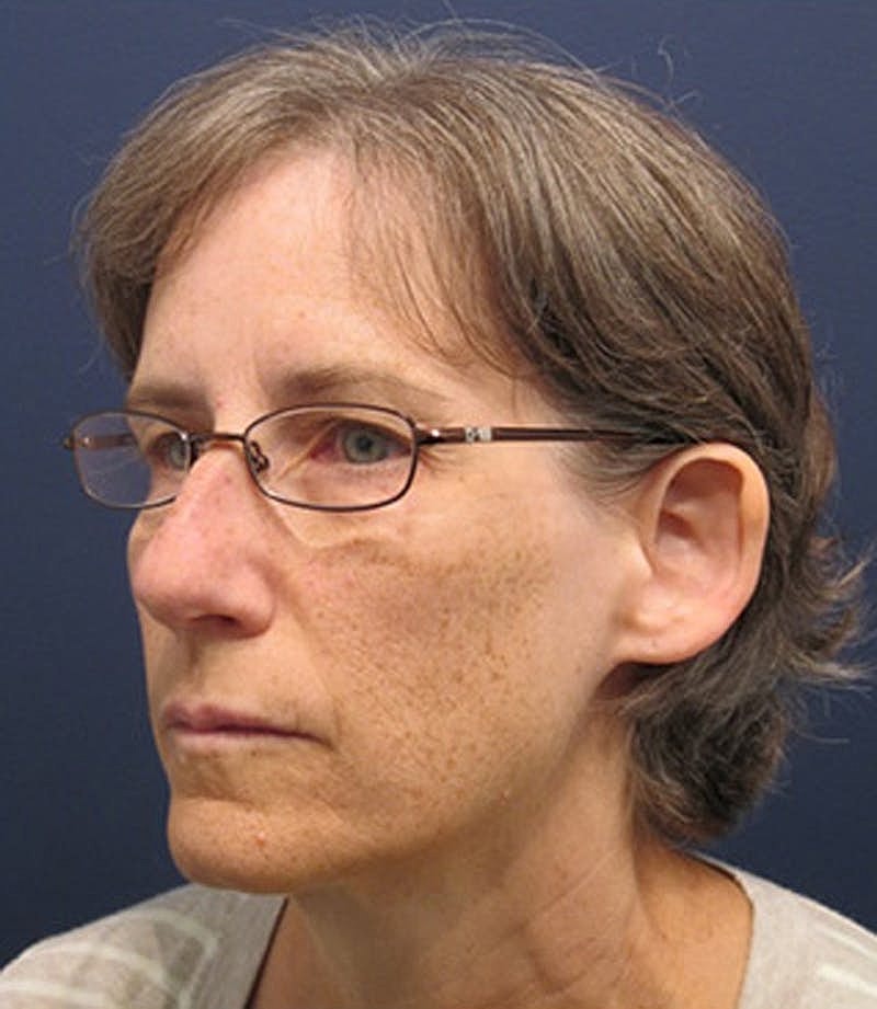 Otoplasty Before & After