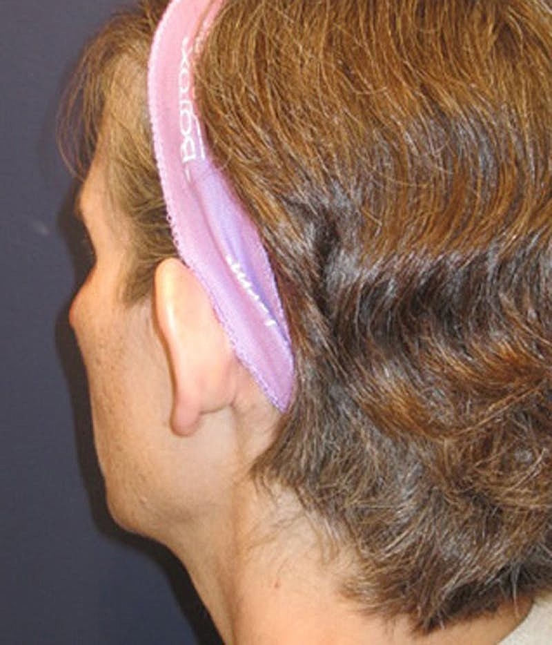 Otoplasty Before & After