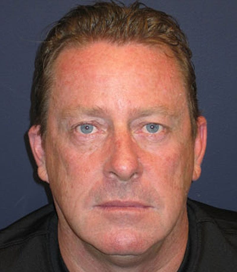 Otoplasty Before & After