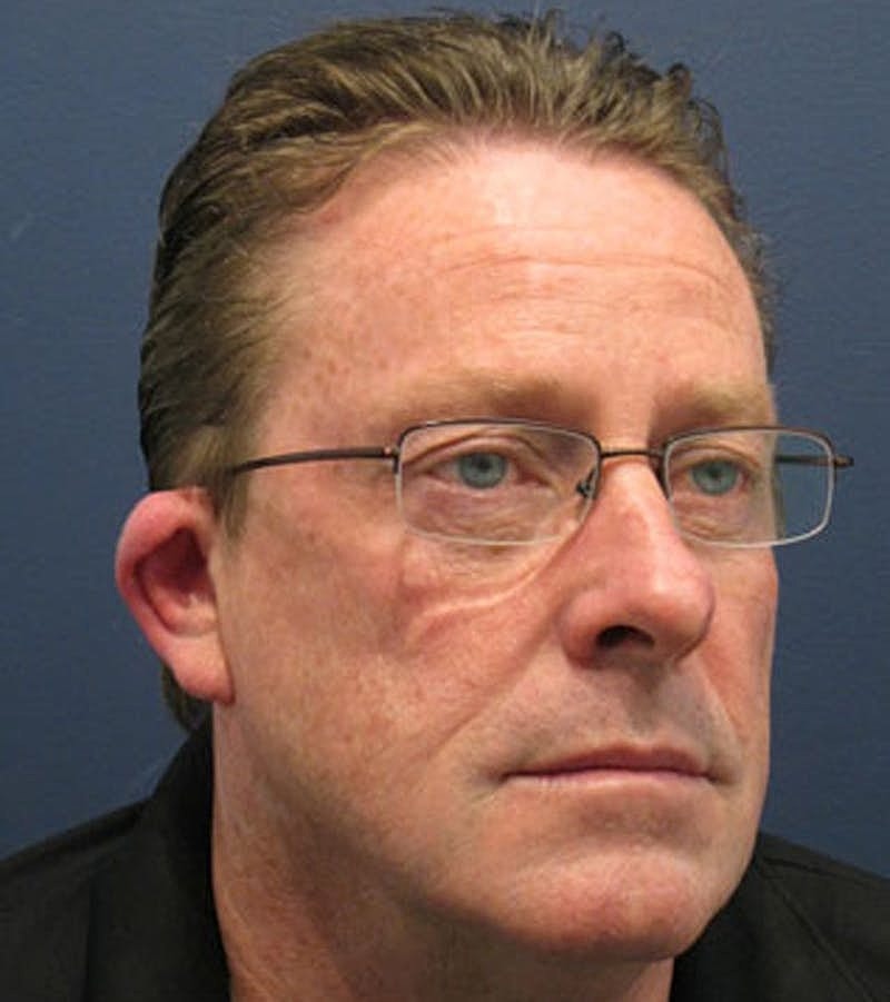 Otoplasty Before & After