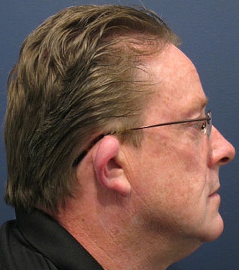 Otoplasty Before & After