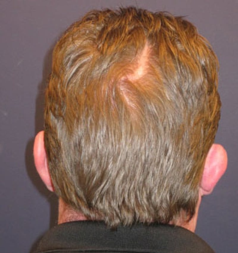 Otoplasty Before & After