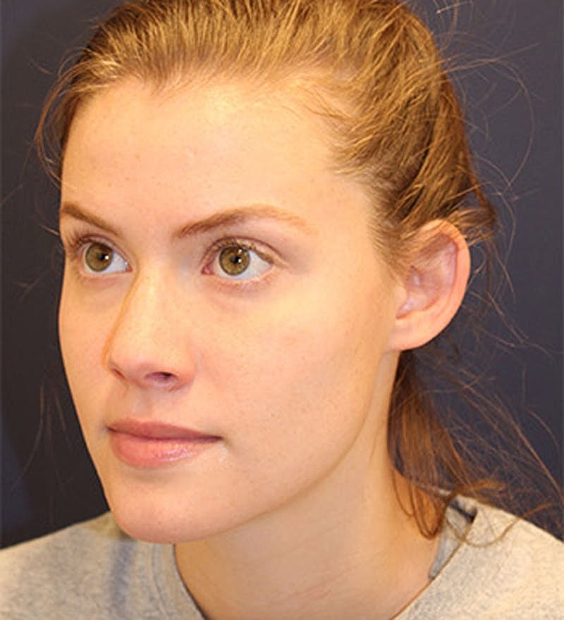 Otoplasty Before & After