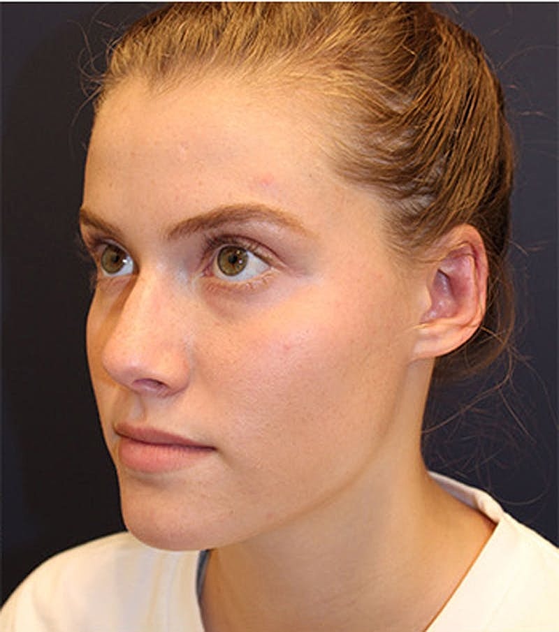 Otoplasty Before & After