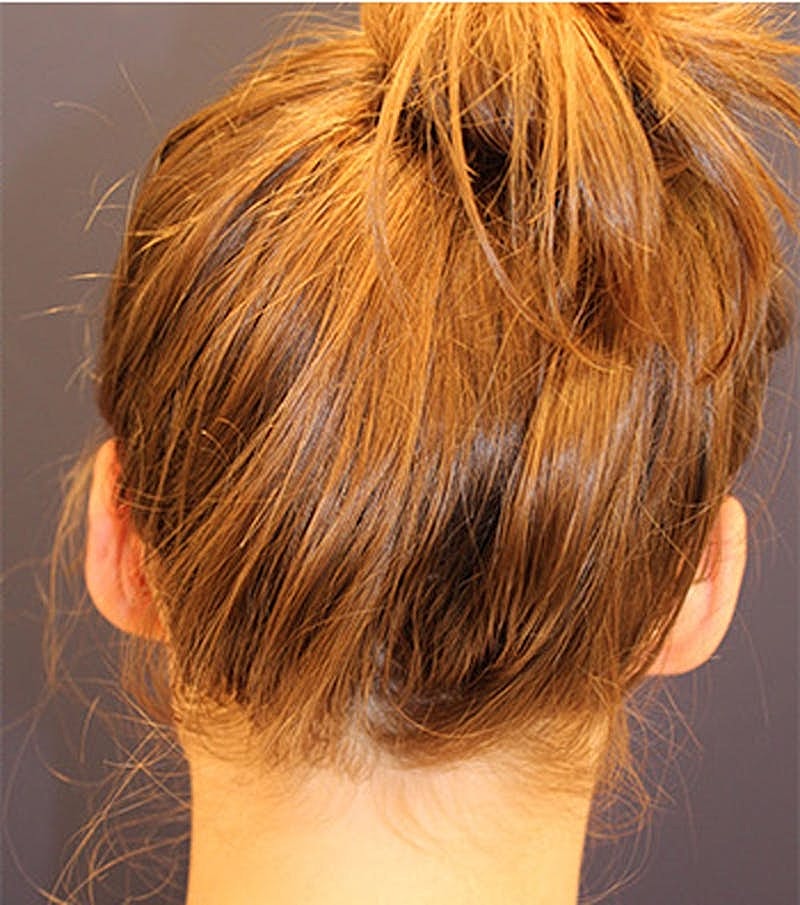 Otoplasty Before & After