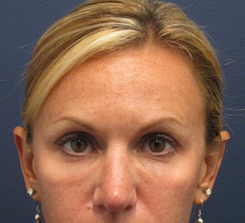 Sculptra Before & After