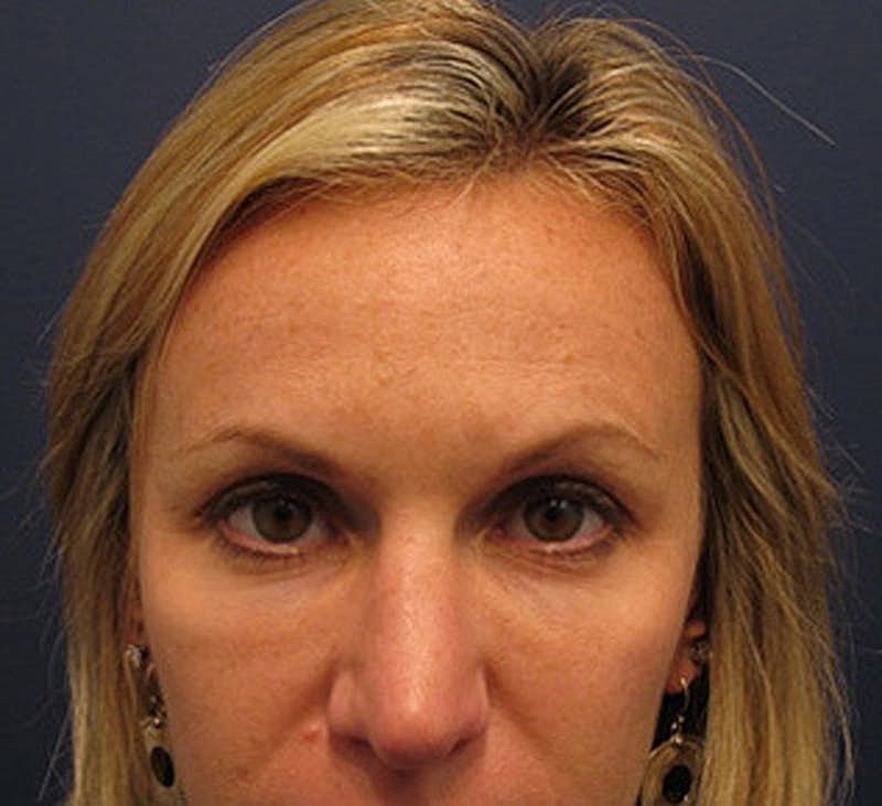 Sculptra Before & After