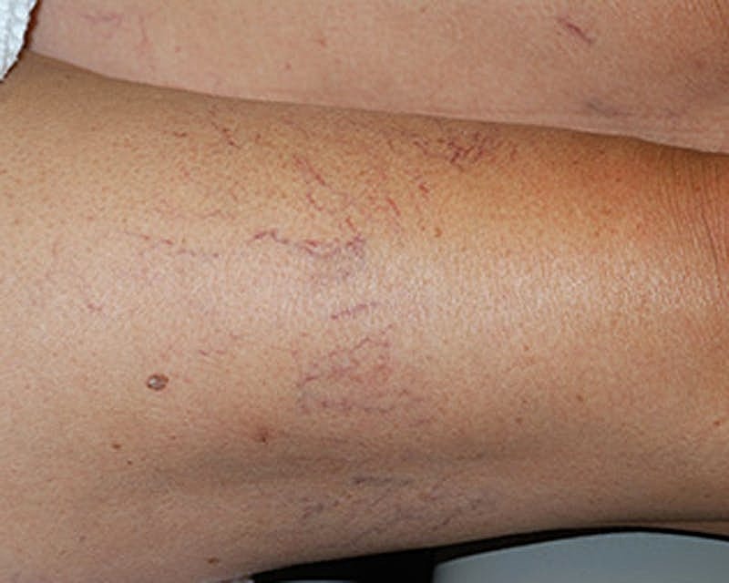 Spider Vein Treatment Before & After