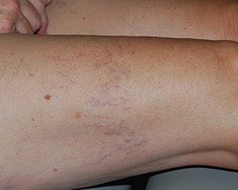 Spider Vein Treatment Before & After