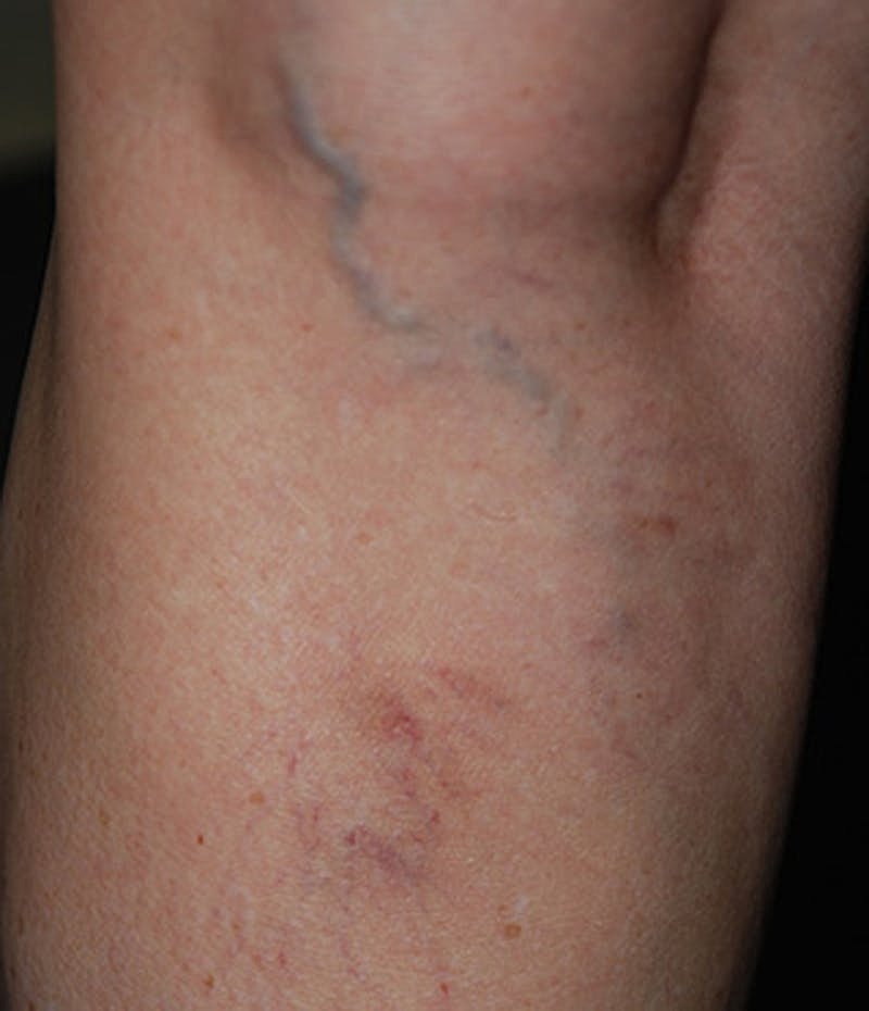 Spider Vein Treatment Before & After