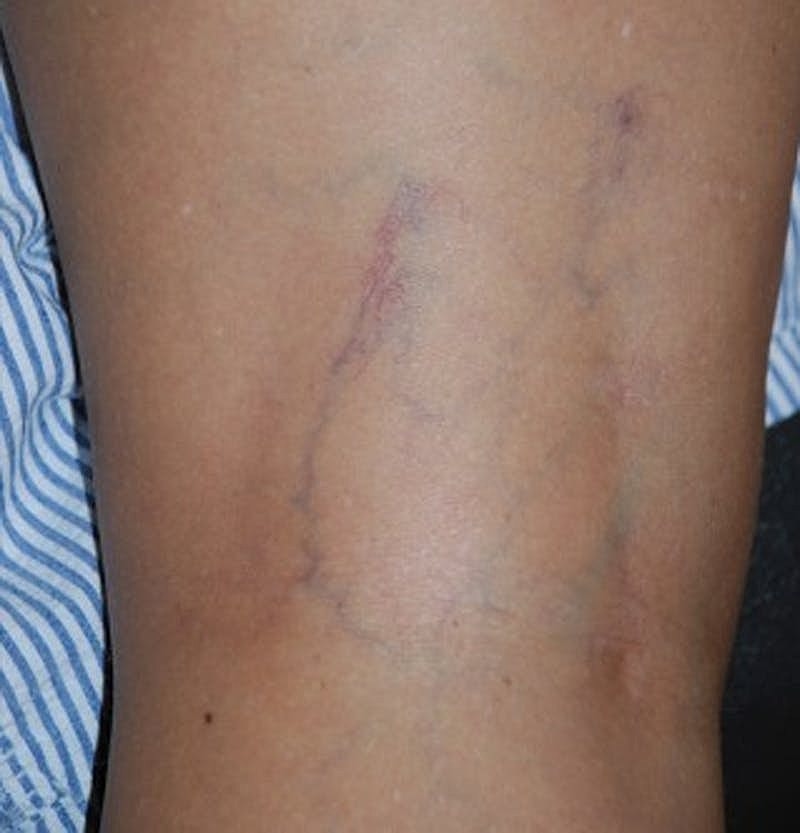 Spider Vein Treatment Before & After