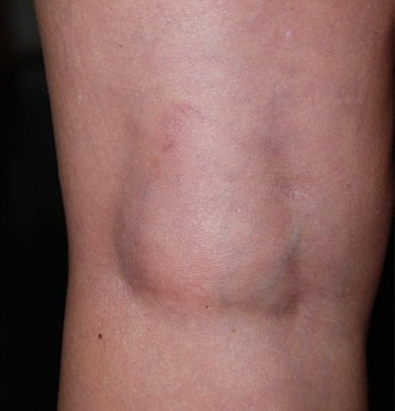 Spider Vein Treatment Before & After
