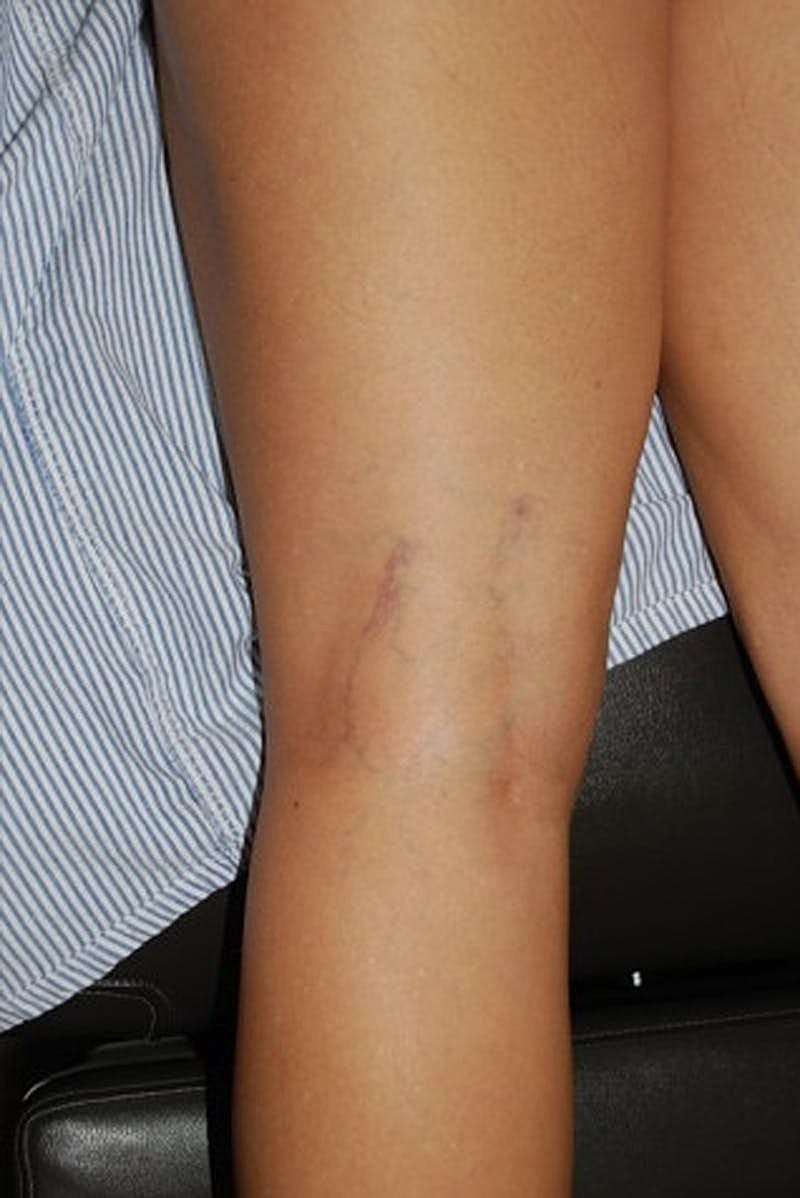 Spider Vein Treatment Before & After