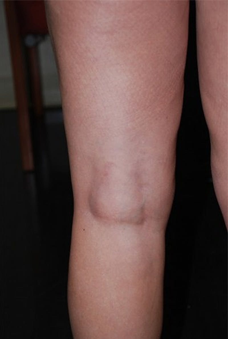 Spider Vein Treatment Before & After