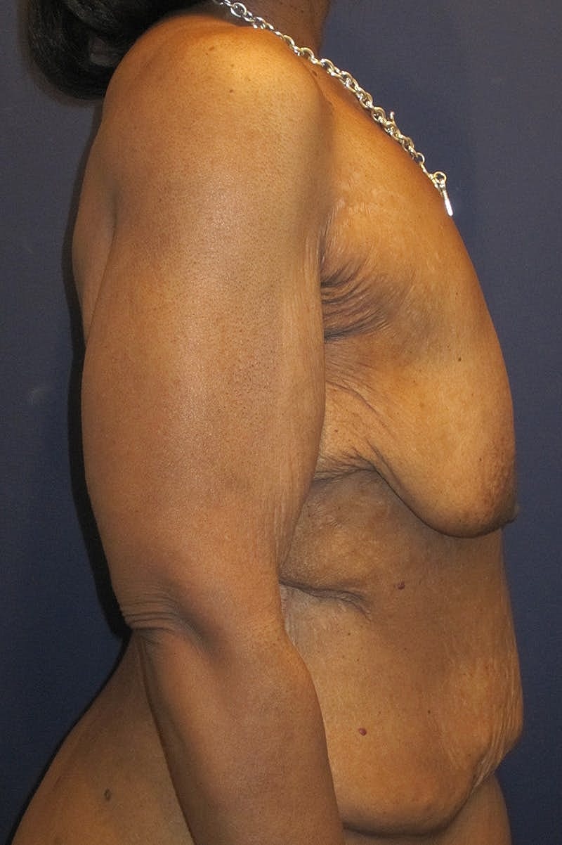 Massive Weight Loss Before & After