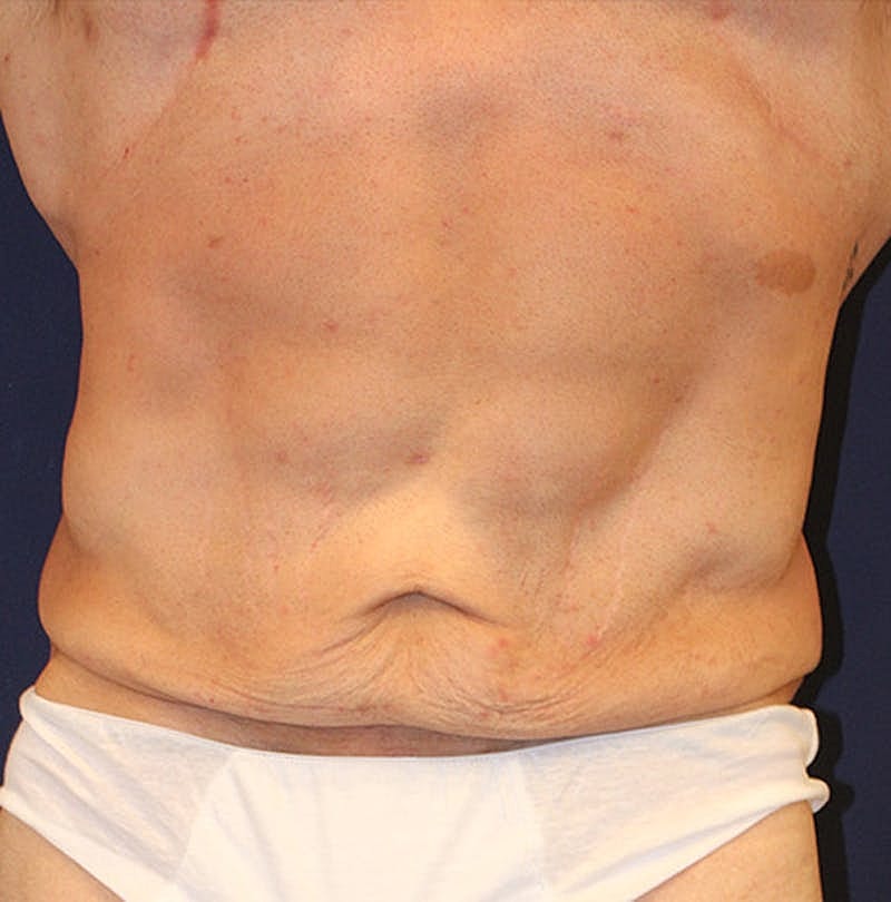 Massive Weight Loss Before & After