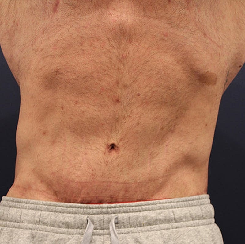 Massive Weight Loss Before & After