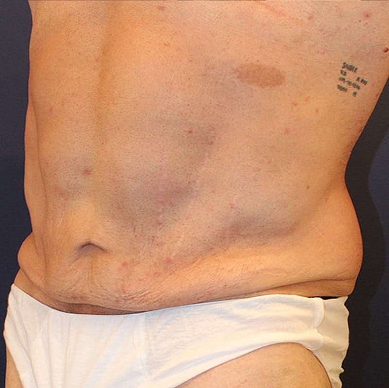 Massive Weight Loss Before & After