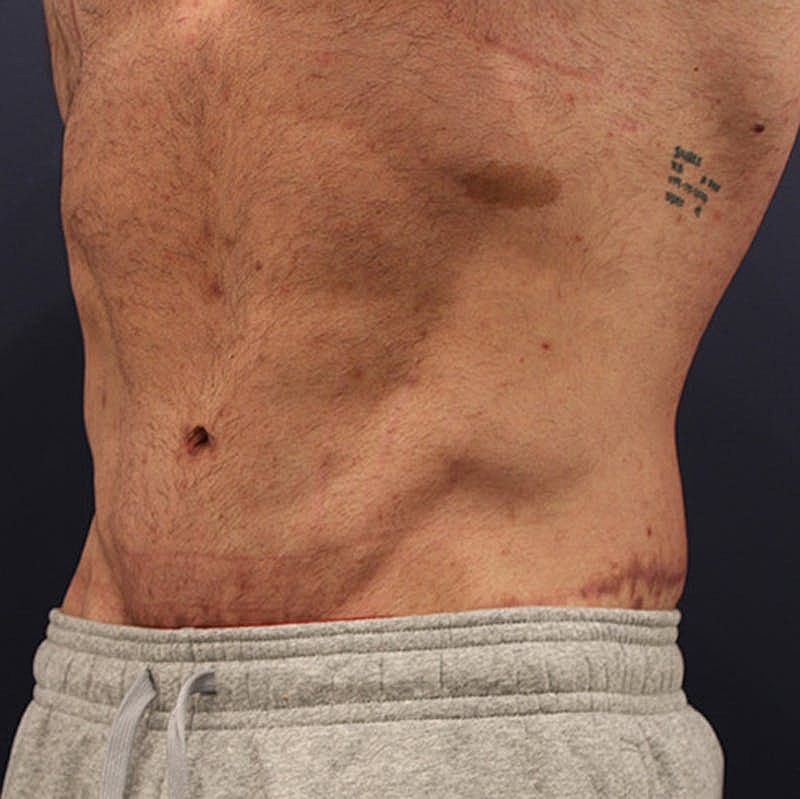 Massive Weight Loss Before & After