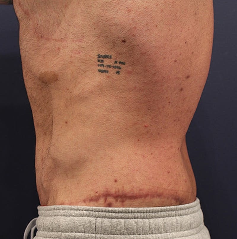 Massive Weight Loss Before & After