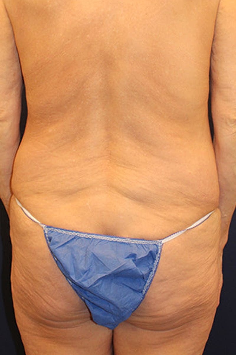 Massive Weight Loss Before & After