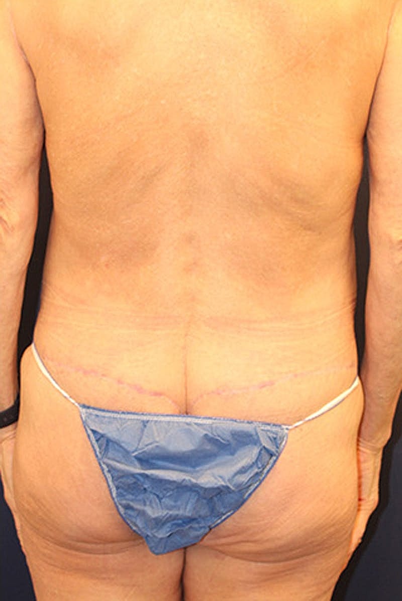 Massive Weight Loss Before & After