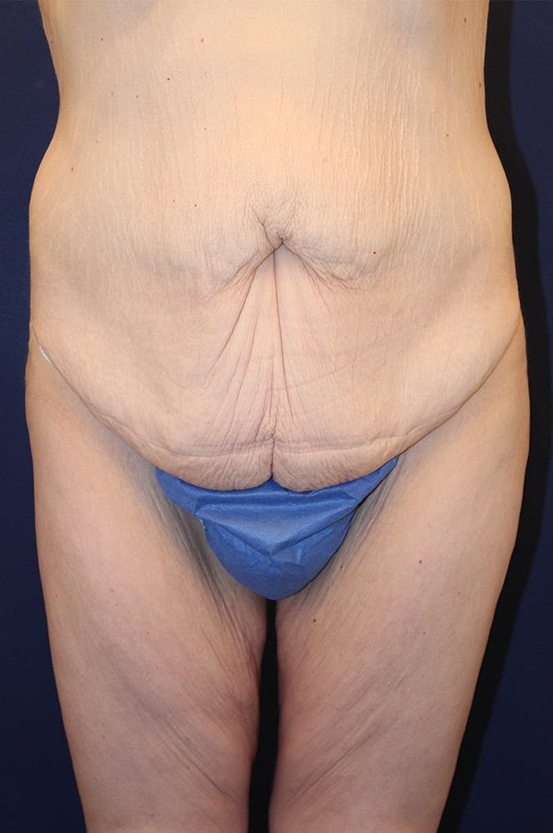 Massive Weight Loss Before & After