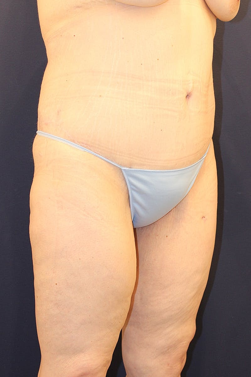 Massive Weight Loss Before & After