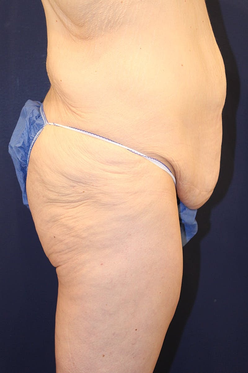 Massive Weight Loss Before & After