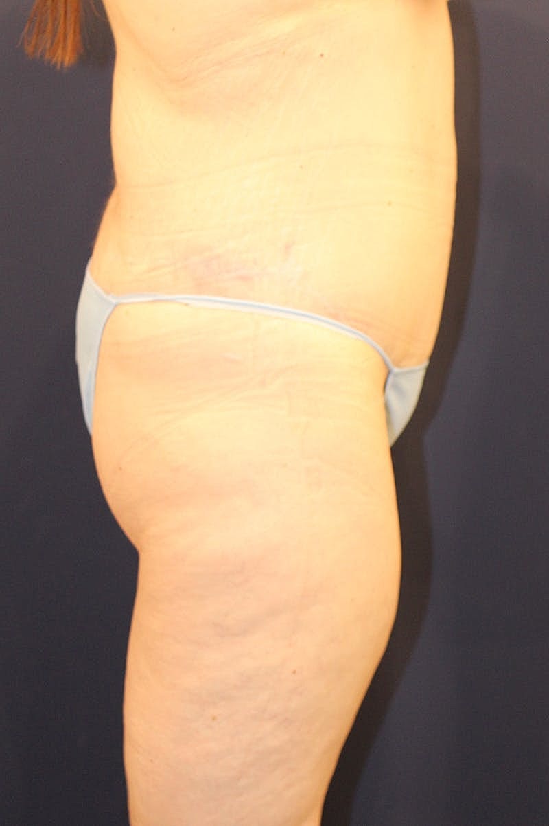 Massive Weight Loss Before & After