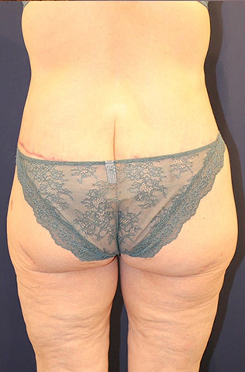 Massive Weight Loss Before & After