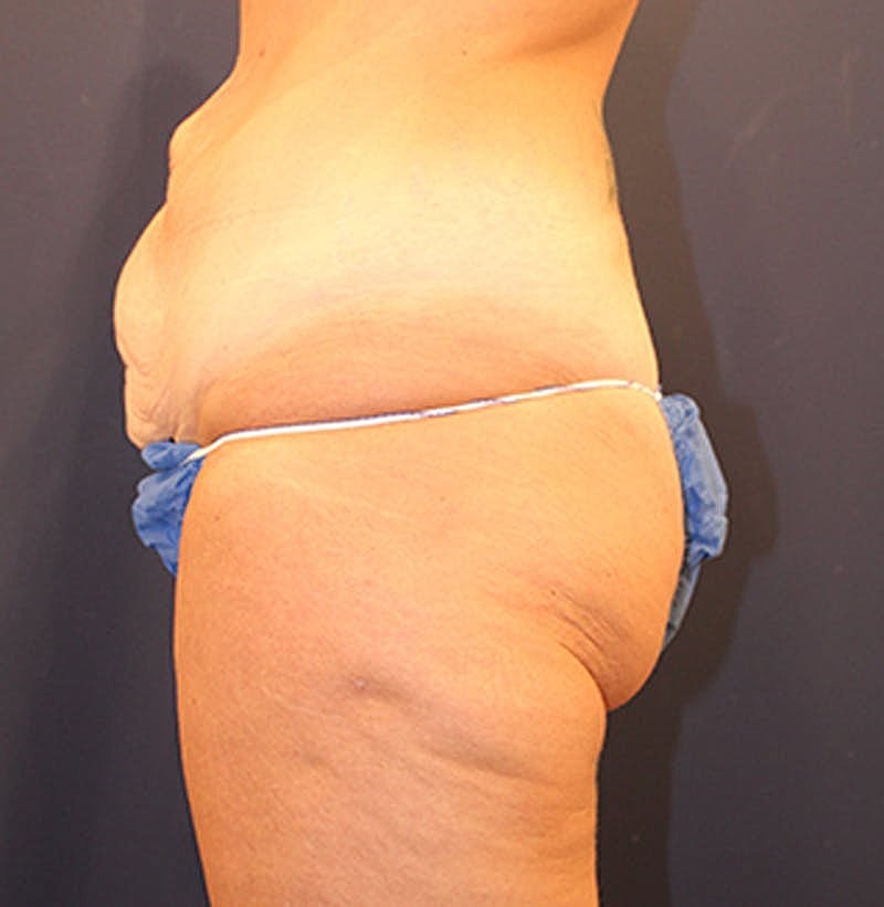 Massive Weight Loss Before & After