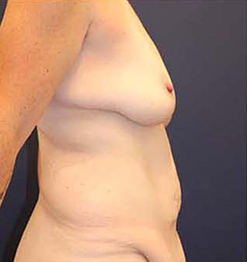 Massive Weight Loss Before & After