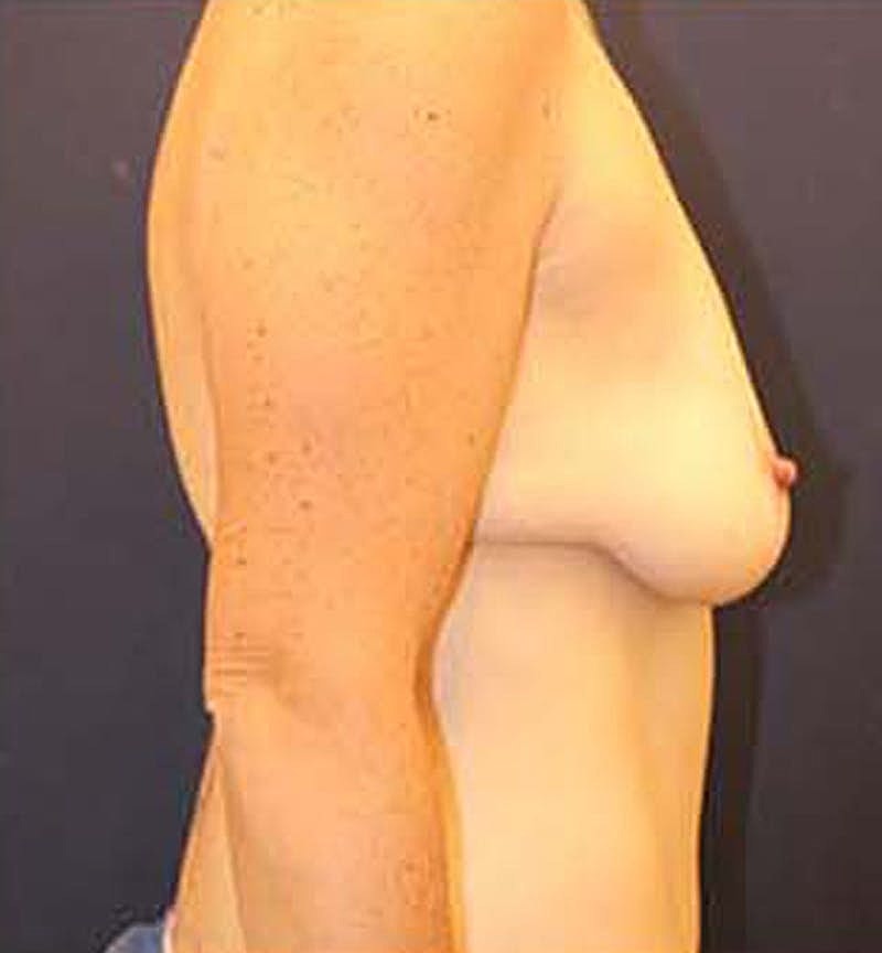 Massive Weight Loss Before & After