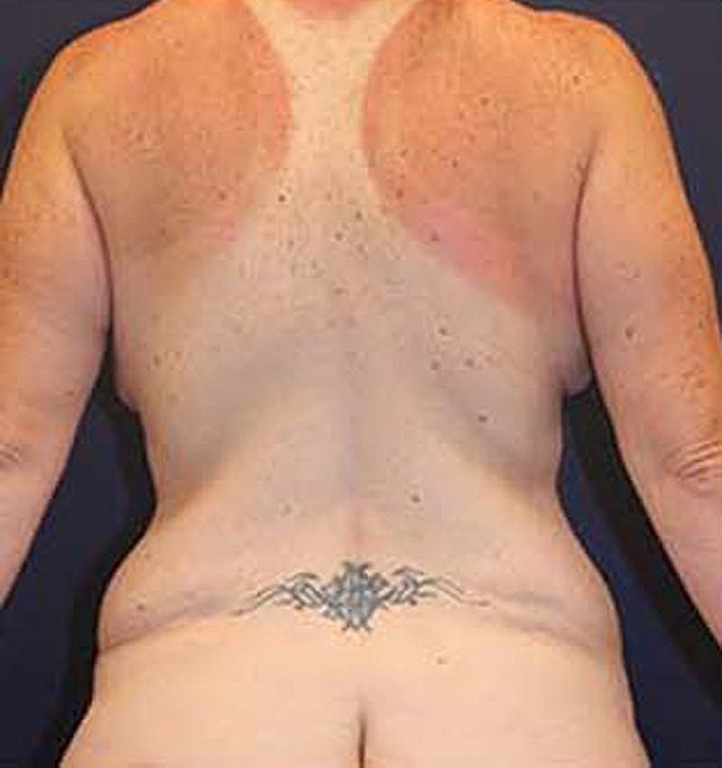 Massive Weight Loss Before & After